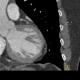 Lipoma of left ventricle: CT - Computed tomography